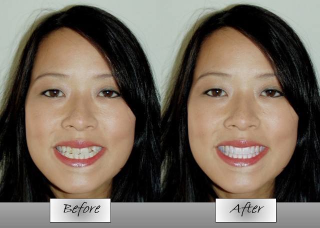 Before and After - Fixed Smile