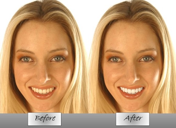 Before and After - Whitening